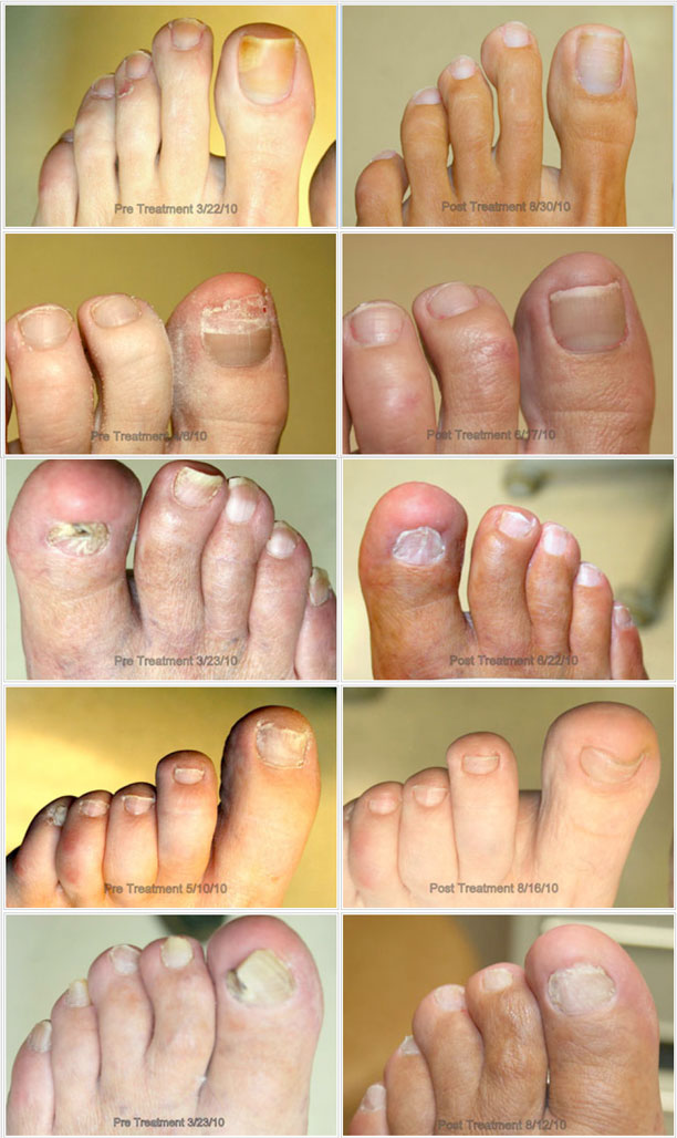 Once the fungus is destroyed in both the nail and nail bed,